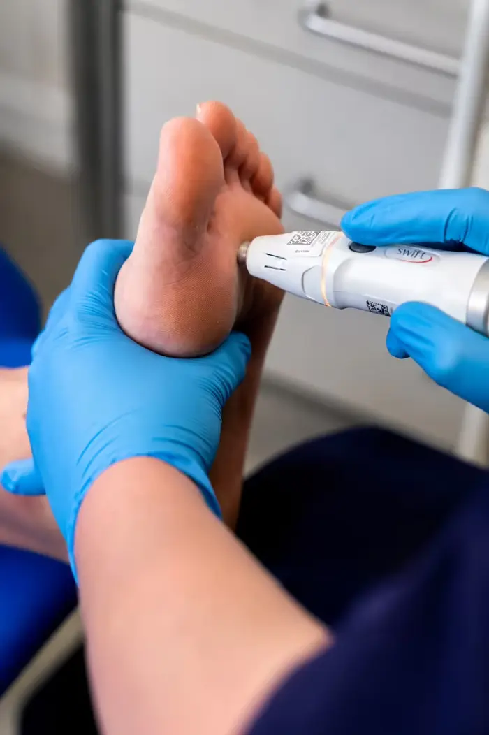 Clinician applying verruca and wart treatment to the sole of a patient foot at Active Step in Fareham